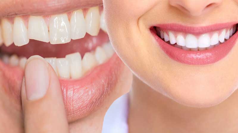 انواع درمان ها در دندانپزشکی ترمیمی و زیبایی