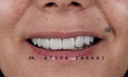 ۸ واحد لمینت سرامیکی دندانهای قدامی فک بالا