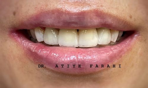 کامپوزیت ونیر فک بالا دندانهای قدامی با لبه کریستالی