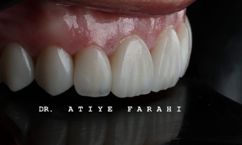 ۸ واحد لمینت سرامیکی دندانهای قدامی فک بالا