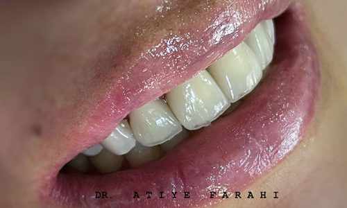 کامپوزیت ونیر فک بالا دندانهای قدامی با لبه کریستالی