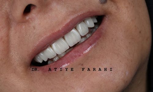 ۸ واحد لمینت سرامیکی دندانهای قدامی فک بالا