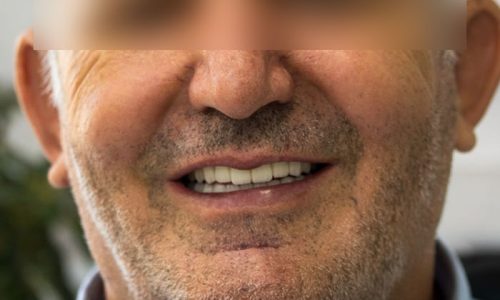 ایمپلنت فول موس