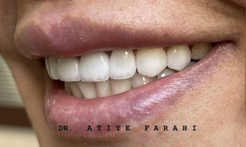 ۸ واحد لمینت سرامیکی دندانهای قدامی فک بالا