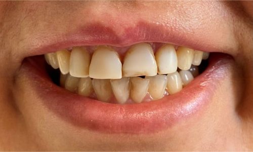 ۸ واحد لمینت سرامیکی دندانهای قدامی فک بالا